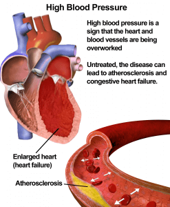 Blood pressure