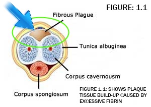 The Peyronie disease