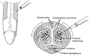 Intracavernosal injection therapy