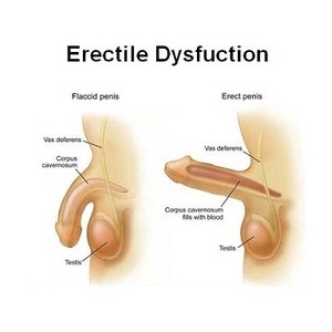 erectile dysfunction