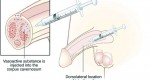 intracavernous injection therapy