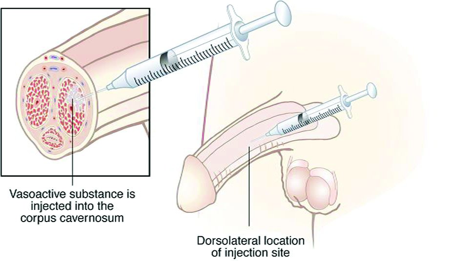 intracavernous injection therapy