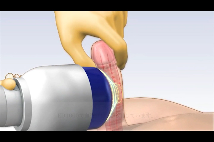 Injection Erectile Dysfunction