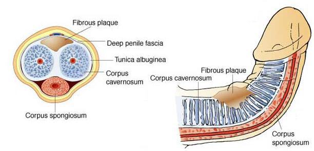 peyronies-disease