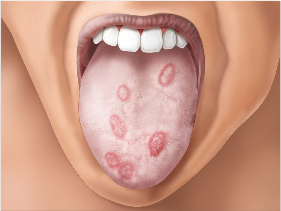 Symptoms of Syphilis