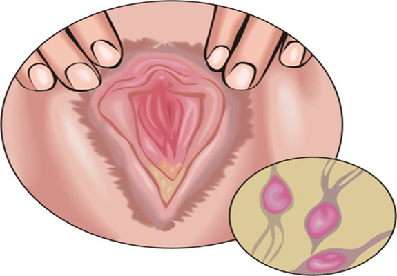 Symptoms of Trichomoniasis