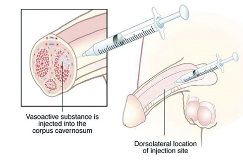 Can Papaverine Be an Alternative to Viagra