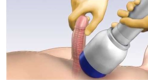 Practical Use of ED Shock Wave Therapy