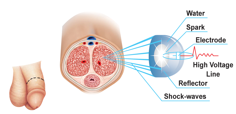 Canadian Pharmacy Survey of the Latest Viagra Alternative Shock Wave Erectile Dysfunction Therapy