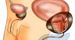 The Triple Use Of Cialis In BPH Patients: ED, BPH And Hypertension