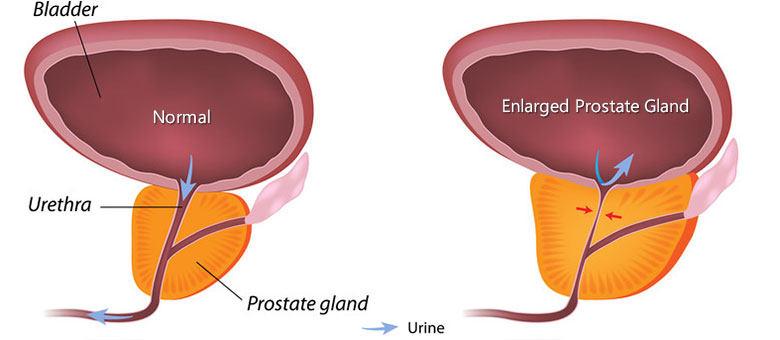 The Triple Use Of Cialis In BPH Patients: Erectile Dysfunction, Benign Prostatic Hypertrophy And Hypertension