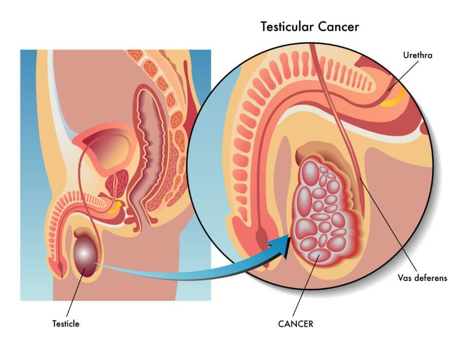 Testicular cancer