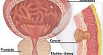 Bladder cancer